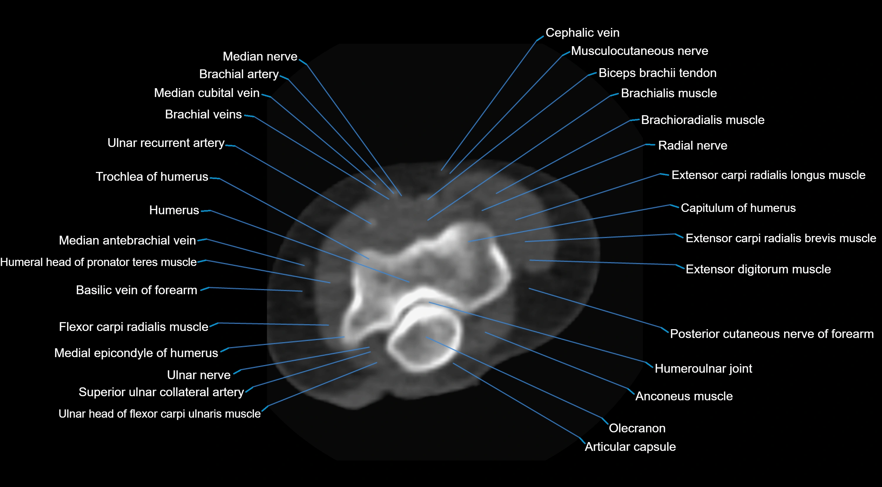 CT elbow axial  cross sectional anatomy labelled  radiology image -00022.webp